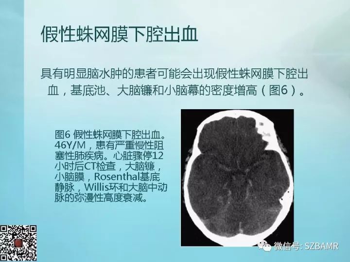 【PPT】非新生儿缺氧缺血性脑病的病理生理学改变及CT和MRI表现