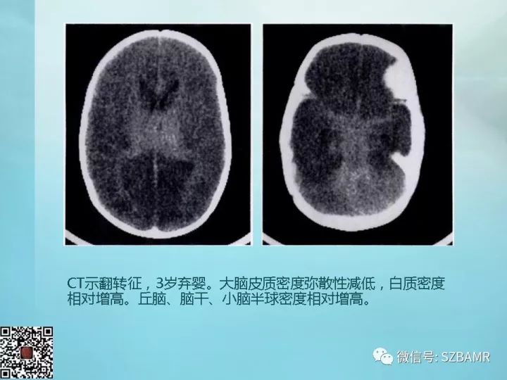 【PPT】非新生儿缺氧缺血性脑病的病理生理学改变及CT和MRI表现