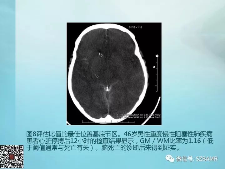 【PPT】非新生儿缺氧缺血性脑病的病理生理学改变及CT和MRI表现