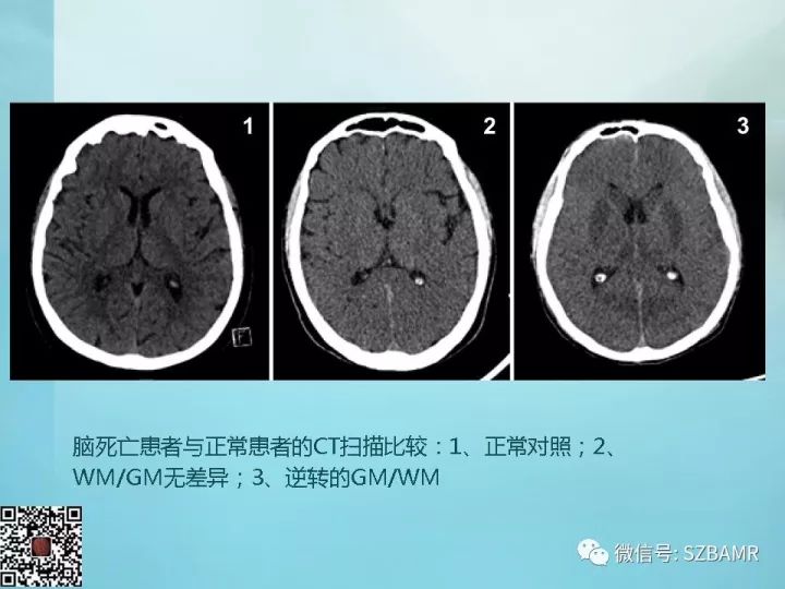 【PPT】非新生儿缺氧缺血性脑病的病理生理学改变及CT和MRI表现