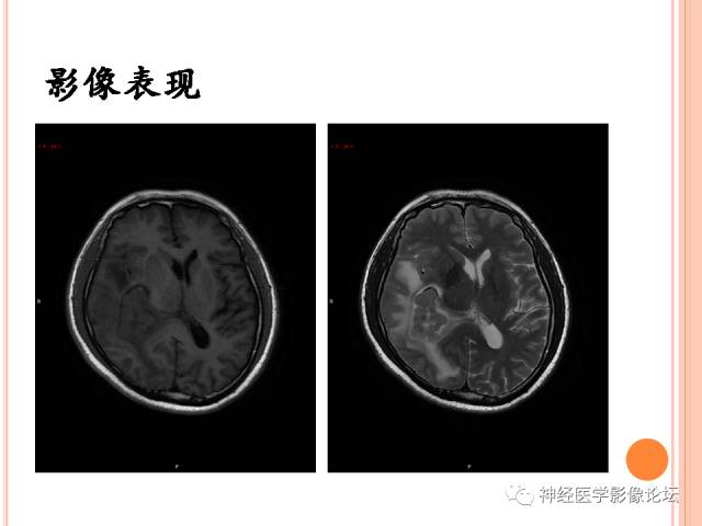 【病例】右侧脑室三角区胶质肉瘤1例MR