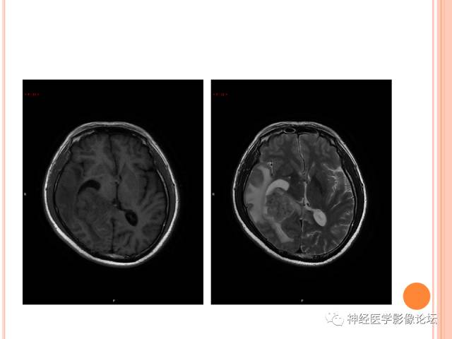 【病例】右侧脑室三角区胶质肉瘤1例MR