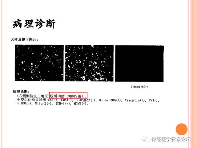 【病例】右侧脑室三角区胶质肉瘤1例MR
