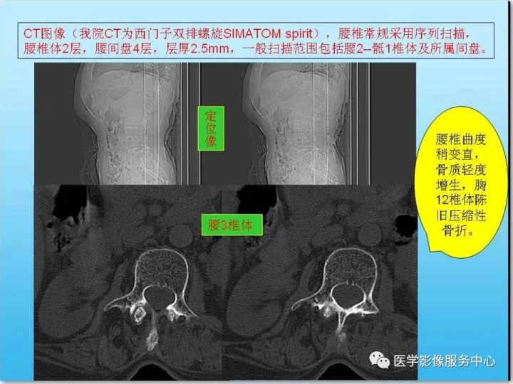 【PPT】一例漏诊腰部CT病例(转移瘤)的启示