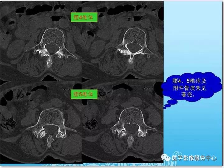 【PPT】一例漏诊腰部CT病例(转移瘤)的启示