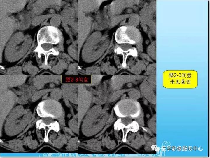 【PPT】一例漏诊腰部CT病例(转移瘤)的启示