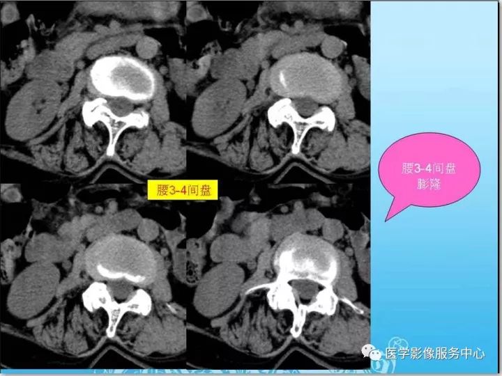 【PPT】一例漏诊腰部CT病例(转移瘤)的启示