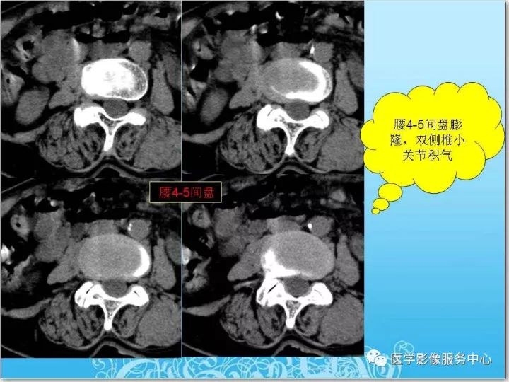 【PPT】一例漏诊腰部CT病例(转移瘤)的启示
