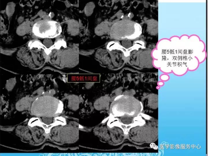 【PPT】一例漏诊腰部CT病例(转移瘤)的启示