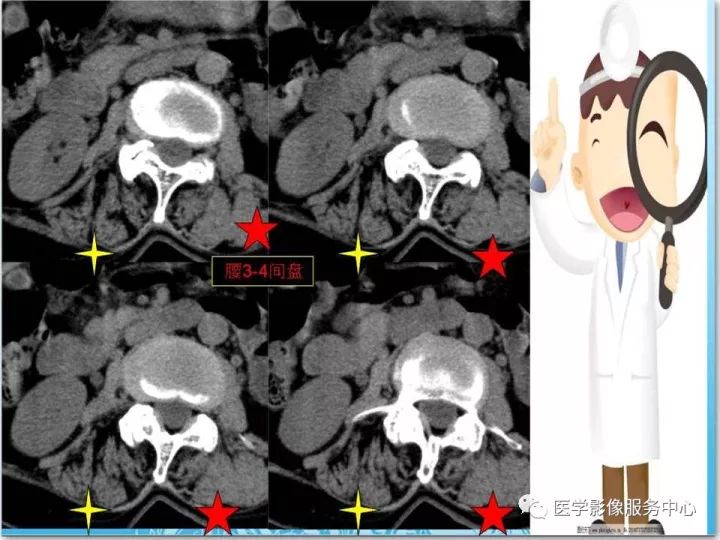 【PPT】一例漏诊腰部CT病例(转移瘤)的启示
