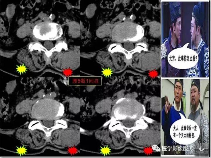 【PPT】一例漏诊腰部CT病例(转移瘤)的启示