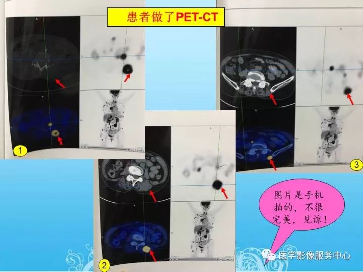 【PPT】一例漏诊腰部CT病例(转移瘤)的启示