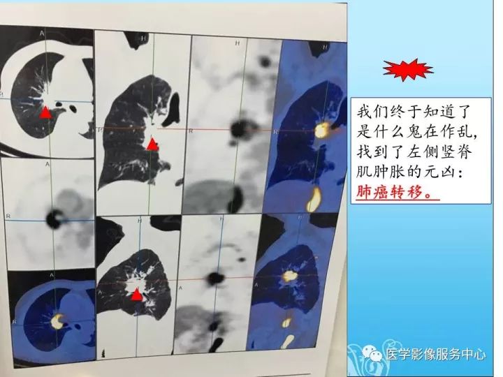 【PPT】一例漏诊腰部CT病例(转移瘤)的启示