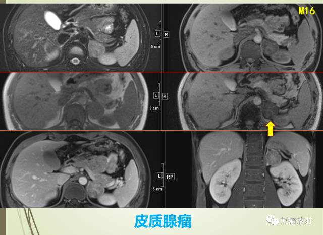 一图秒懂丨非医源性皮质醇增多症之各类肾上腺病变的表现