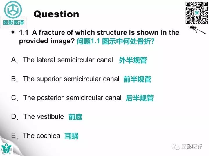 【病例】累及听软骨囊的颞骨骨折1例CT