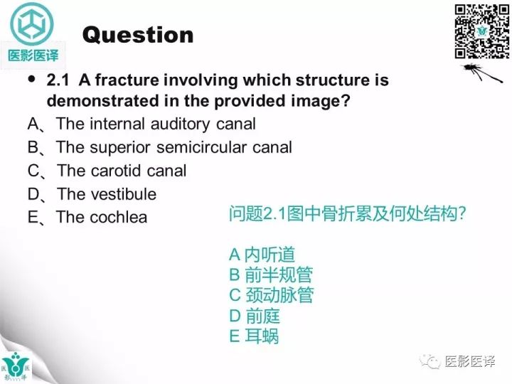 【病例】累及听软骨囊的颞骨骨折1例CT