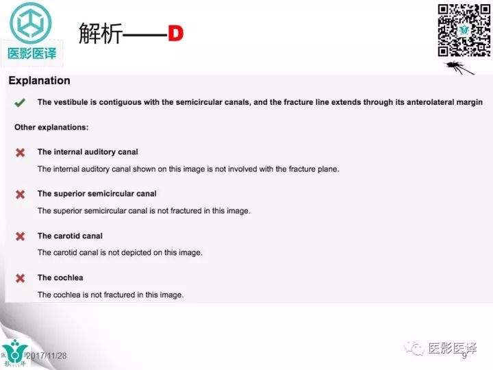 【病例】累及听软骨囊的颞骨骨折1例CT