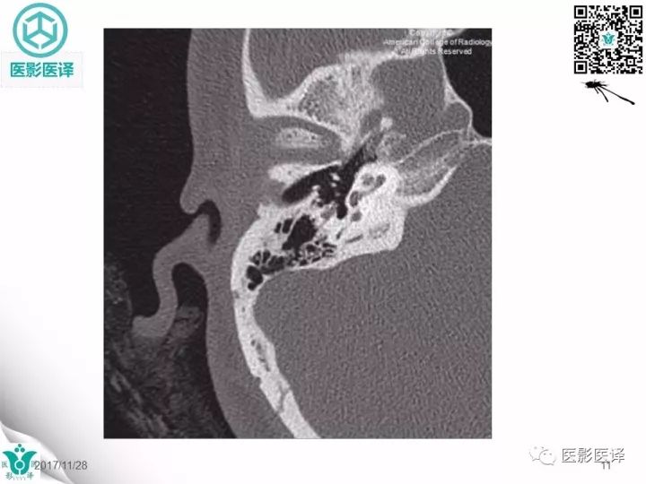 【病例】累及听软骨囊的颞骨骨折1例CT