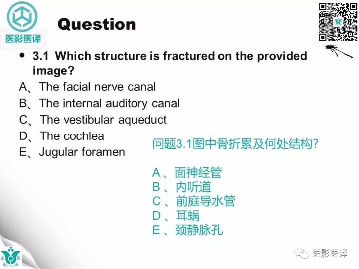 【病例】累及听软骨囊的颞骨骨折1例CT