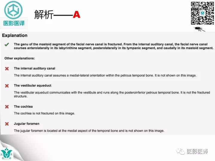 【病例】累及听软骨囊的颞骨骨折1例CT