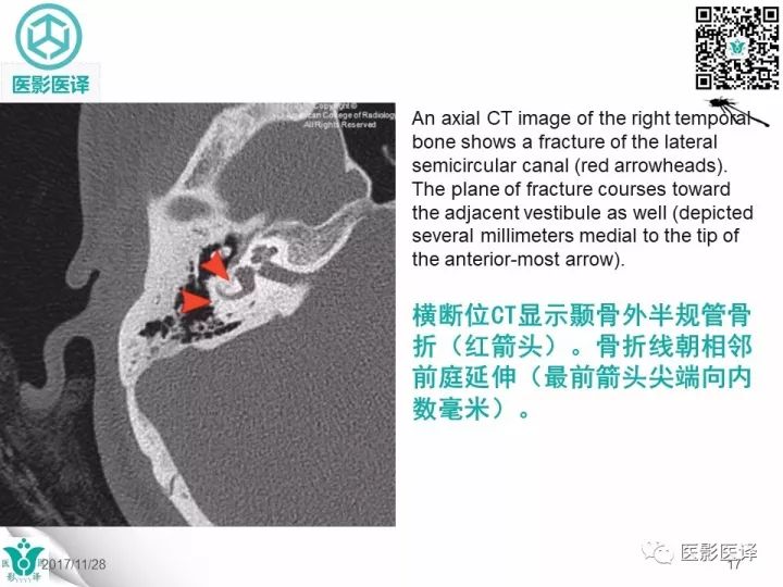 【病例】累及听软骨囊的颞骨骨折1例CT