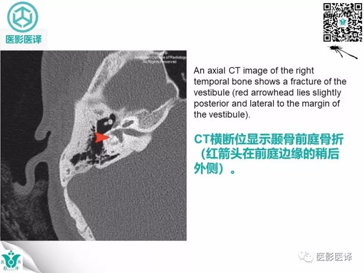 【病例】累及听软骨囊的颞骨骨折1例CT