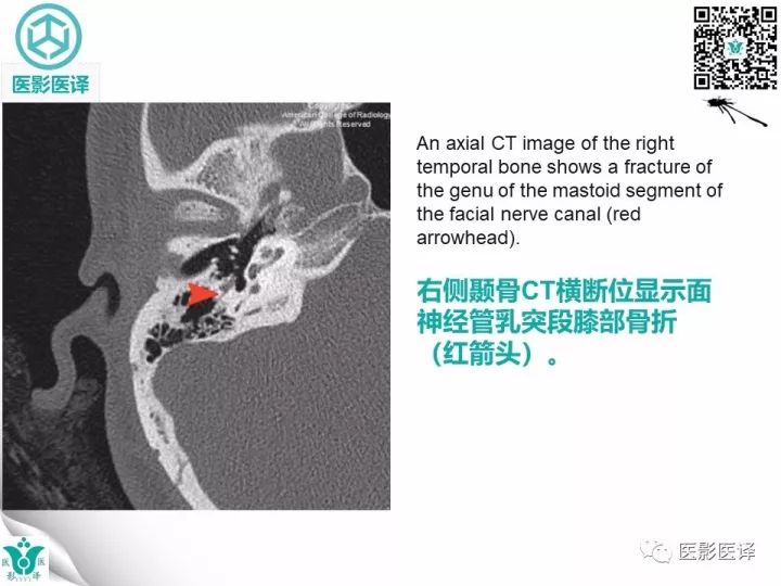 【病例】累及听软骨囊的颞骨骨折1例CT