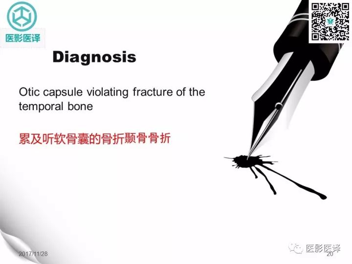 【病例】累及听软骨囊的颞骨骨折1例CT