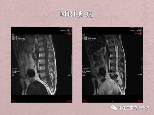 【病例】脊髓腰骶段粘液乳头型室管膜瘤1例MR
