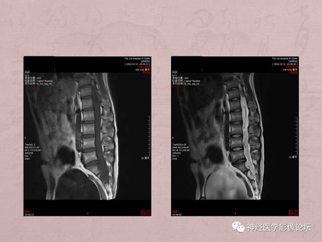 【病例】脊髓腰骶段粘液乳头型室管膜瘤1例MR