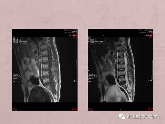 【病例】脊髓腰骶段粘液乳头型室管膜瘤1例MR