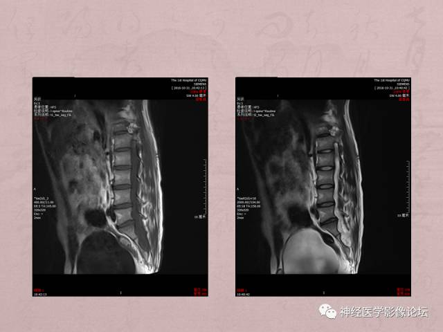 【病例】脊髓腰骶段粘液乳头型室管膜瘤1例MR