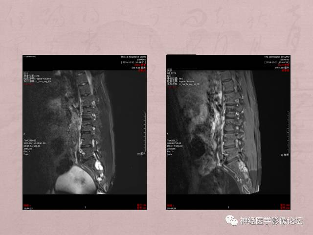 【病例】脊髓腰骶段粘液乳头型室管膜瘤1例MR
