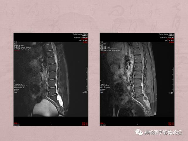 【病例】脊髓腰骶段粘液乳头型室管膜瘤1例MR