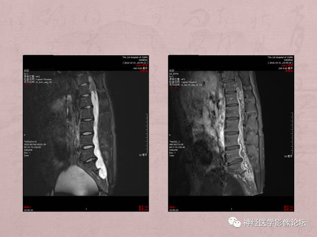 【病例】脊髓腰骶段粘液乳头型室管膜瘤1例MR