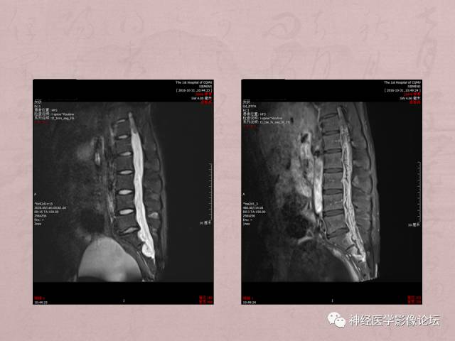 【病例】脊髓腰骶段粘液乳头型室管膜瘤1例MR