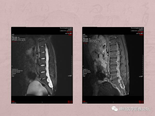 【病例】脊髓腰骶段粘液乳头型室管膜瘤1例MR