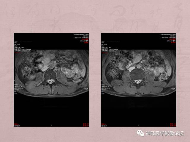 【病例】脊髓腰骶段粘液乳头型室管膜瘤1例MR