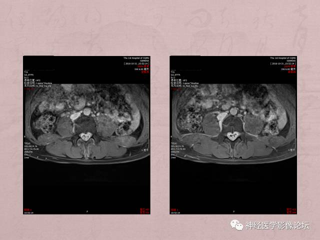 【病例】脊髓腰骶段粘液乳头型室管膜瘤1例MR