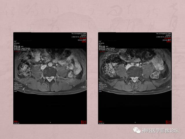 【病例】脊髓腰骶段粘液乳头型室管膜瘤1例MR