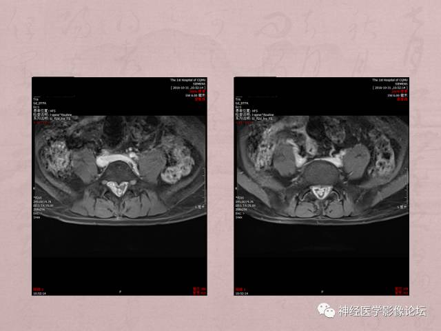 【病例】脊髓腰骶段粘液乳头型室管膜瘤1例MR