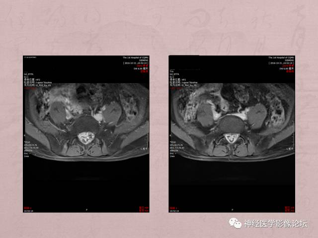 【病例】脊髓腰骶段粘液乳头型室管膜瘤1例MR
