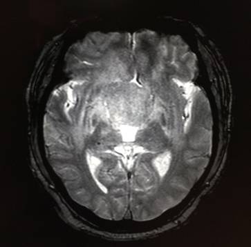 【病例】鞍上室管膜瘤1例MR影像表现 【病例】鞍上室管膜瘤1例MR影像表现