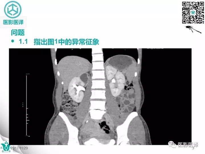 【病例】肾盂输尿管重复畸形伴异位输尿管开口于阴道壁1例CT
