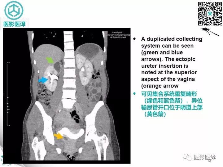 【病例】肾盂输尿管重复畸形伴异位输尿管开口于阴道壁1例CT