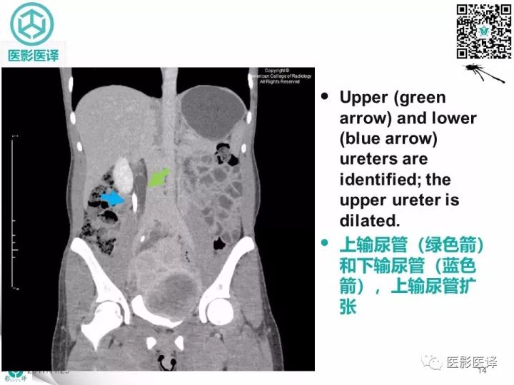 【病例】肾盂输尿管重复畸形伴异位输尿管开口于阴道壁1例CT