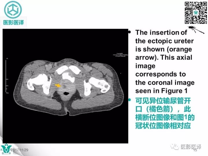 【病例】肾盂输尿管重复畸形伴异位输尿管开口于阴道壁1例CT