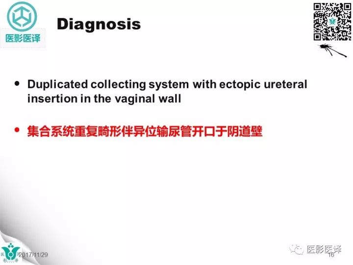【病例】肾盂输尿管重复畸形伴异位输尿管开口于阴道壁1例CT