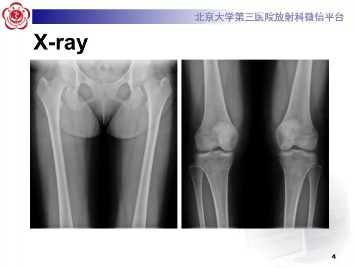 【病例】骨梗死1例MR影像诊断