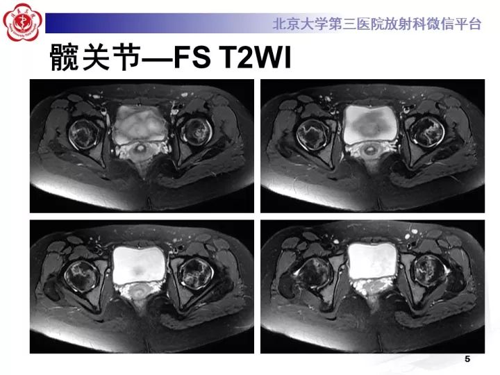 【病例】骨梗死1例MR影像诊断